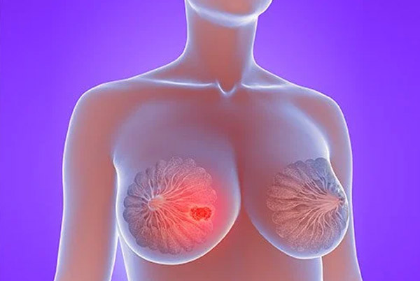 Hầu hết u vú ở phụ nữ là u nang vú hoặc u sợi tuyến, không phải ung thư vú